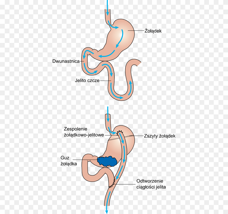 Diagram Showing Before And After Stomach Bypass Surgery, Body Part, Animal, Reptile, Snake Free Png Download