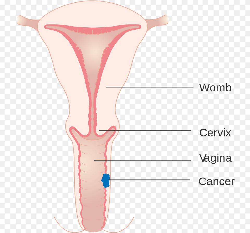 Diagram Showing Stage 1 Vaginal Cancer Cruk Symmetry, Chart, Plot Png