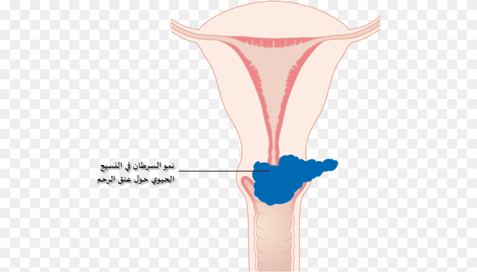 Diagram Showing Stage 2b Cervical Cancer Cruk 216 Ar Cervical Cancer, Person Free Png