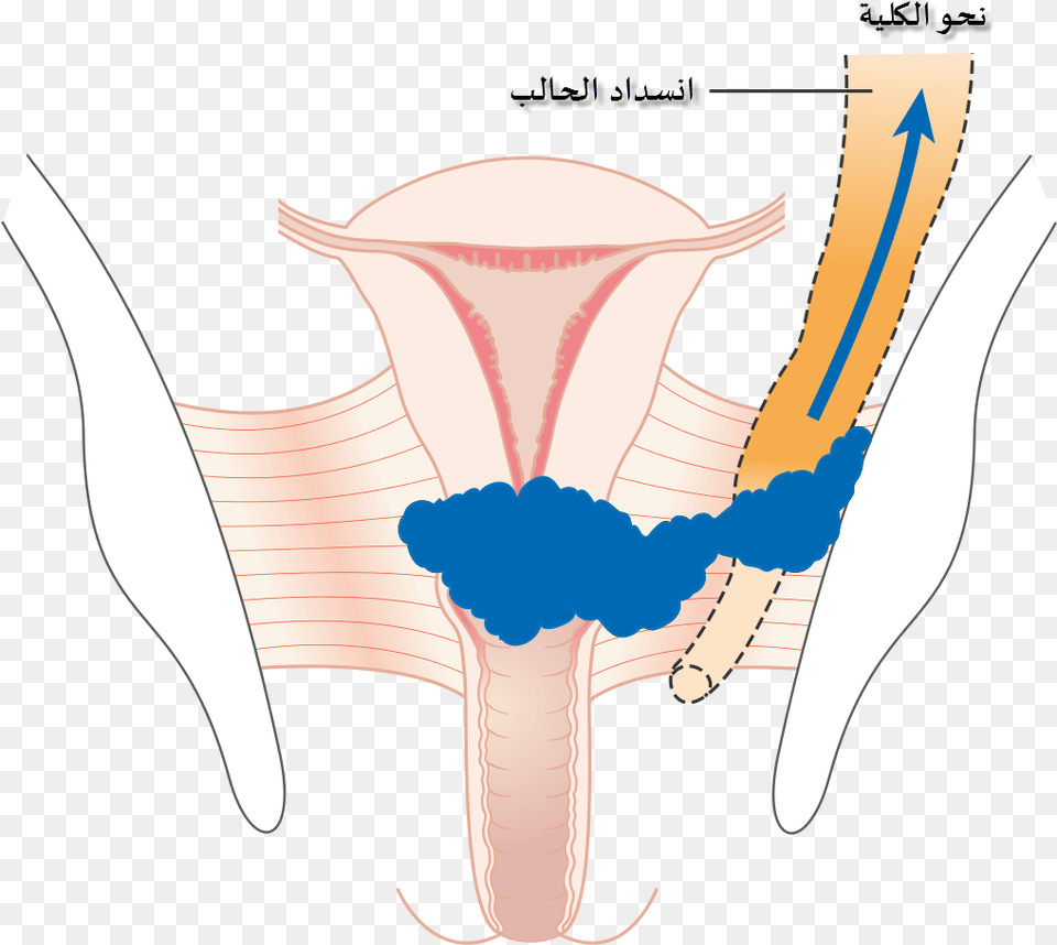Diagram Showing Stage 3b Cervical Cancer Cruk 226 Ar Stage 3 Cervical Cancer, Head, Person, Body Part, Neck Png