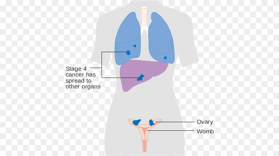 Diagram Showing Stage 4 Ovarian Cancer Cruk Ovaries And Liver, Ct Scan Png