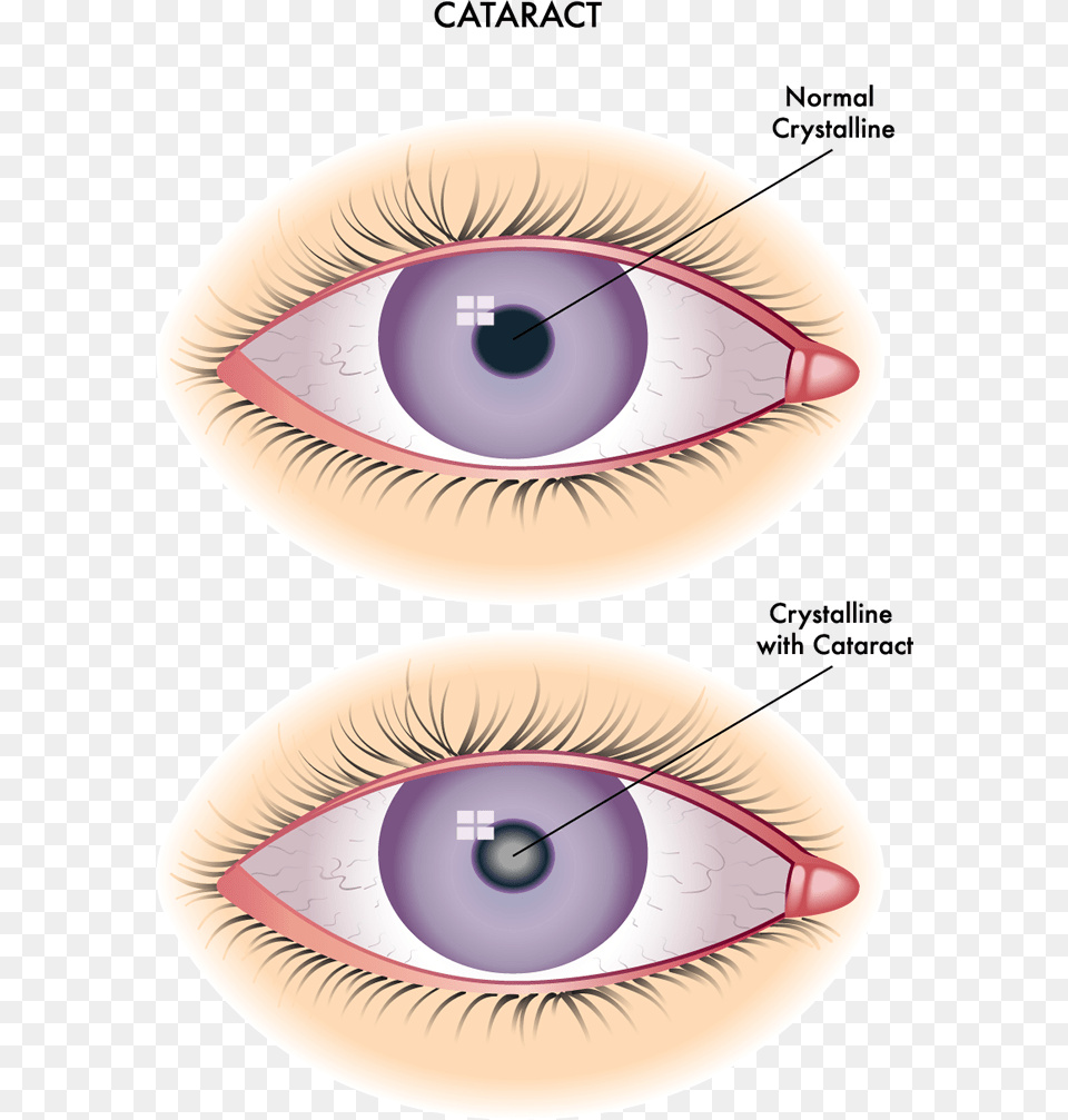 Difference Between Cataract And Corneal Opacity, Contact Lens, Disk Free Png Download