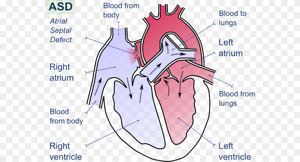 Difference Between Left And Right Side Of Heart Fig Atrial Septal Defect, Person, Chart, Plot, Face Png Image