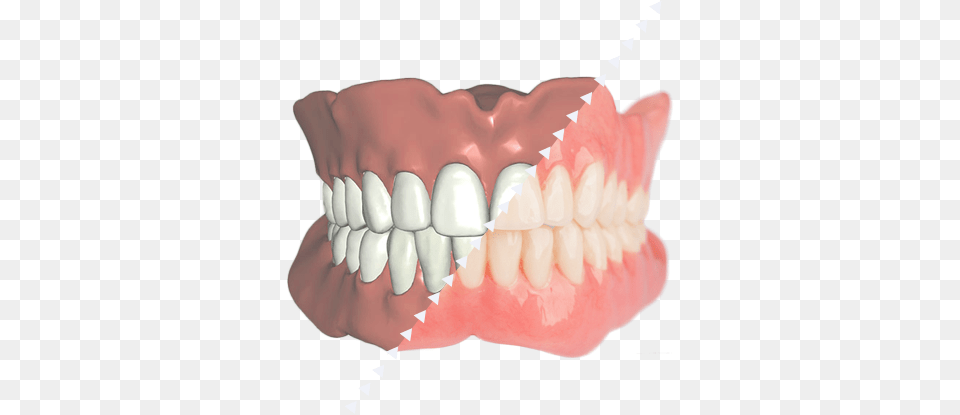 Digital Denture Jaw, Teeth, Body Part, Person, Mouth Free Png Download