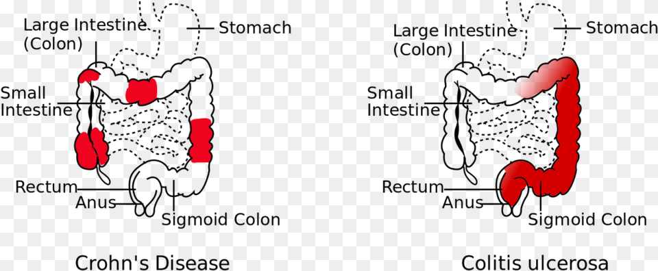 Disease Vs Colitis Ulcerosa Difference Between Crohns And Ulcerative Colitis, Text Free Transparent Png