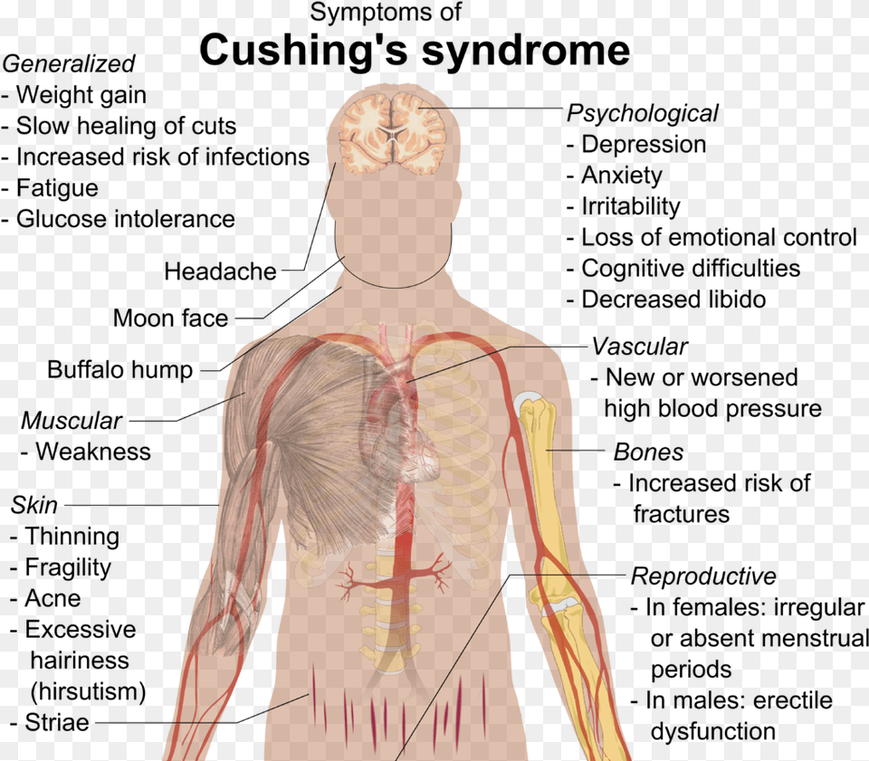 Diseases Of The Hypothalamus Pituitary Adrenal Axis Cushing Syndrome, Adult, Male, Man, Person Png