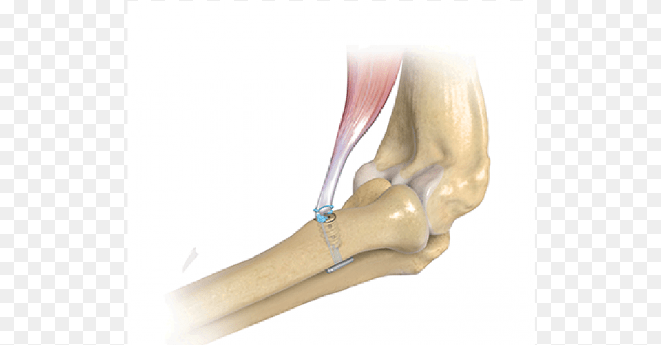 Distal Biceps Repair The Biceps Button And Tension Slide Biceps, Smoke Pipe, Ankle, Body Part, Person Png Image