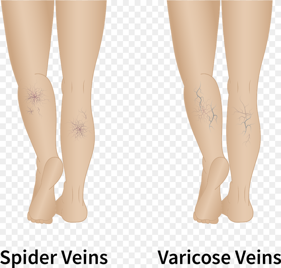 Distinguishing Spider Veins From Varicose Veins Tights, Person, Skin, Tattoo, Adult Png Image