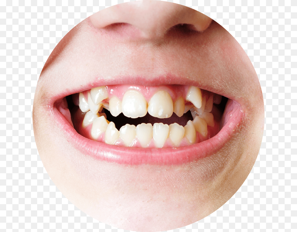 Do Teeth Grow Crooked Irregular Teeth, Body Part, Mouth, Person, Baby Free Png