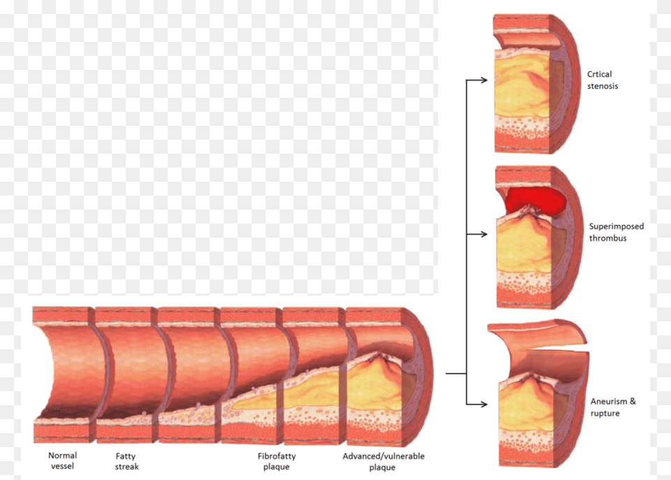 Download Atherosclerosis Clipart Atherosclerosis Atherosclerosis Stenosis, Architecture, Building, Housing, House Png Image