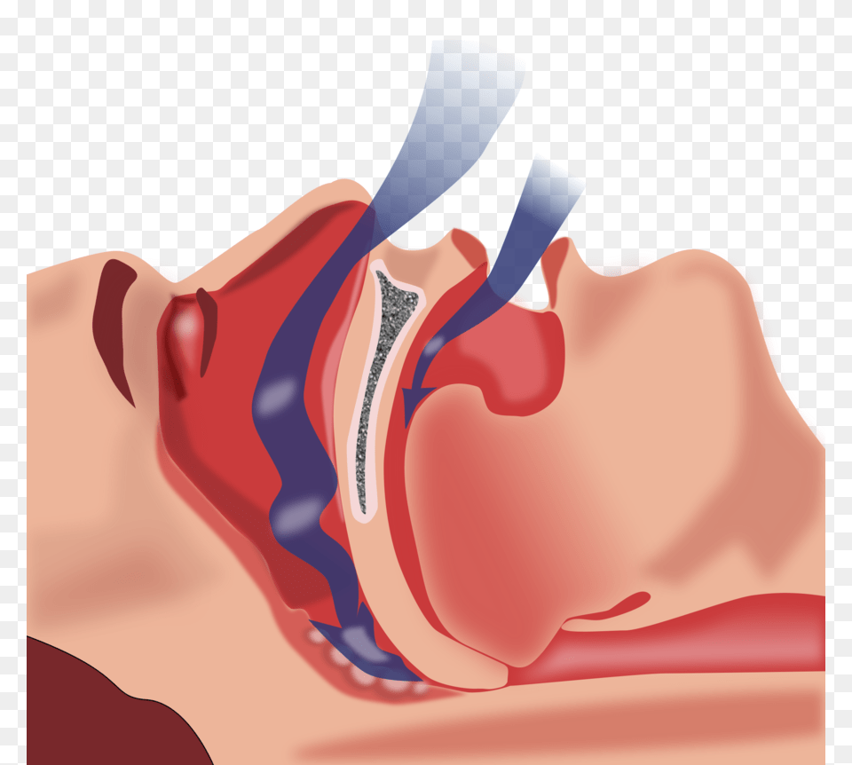 Download Cpap Treatment For Obstructive Sleep Apnea Clipart, Body Part, Face, Head, Neck Png