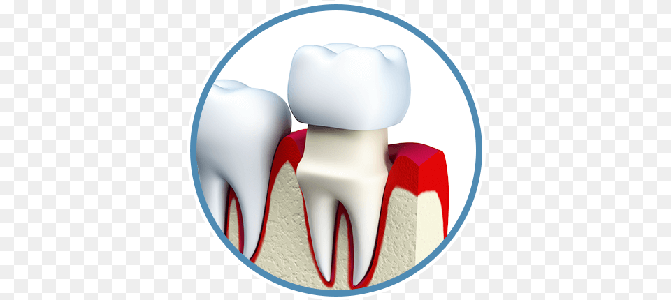 Download Hd Dental Crowns Tooth Porcelain Figure Tooth Crown Fell Out, Body Part, Cream, Dessert, Food Png