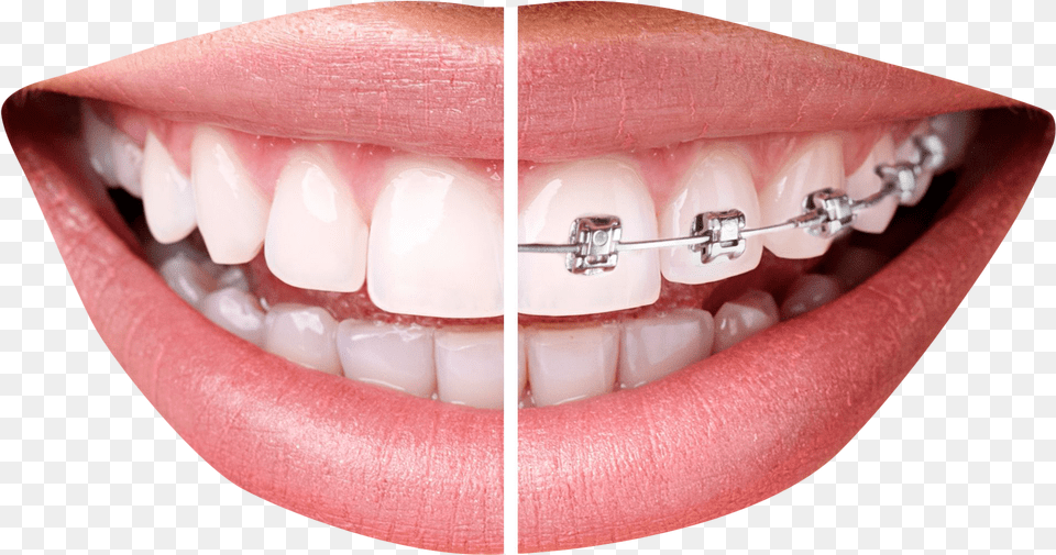 Teeth With Braces Tooth Braces, Body Part, Mouth, Person, Tape Free Png Download