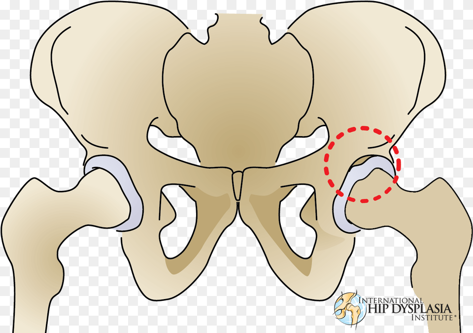Dysplasia Labrum, Baby, Person, Body Part, Hip Free Transparent Png