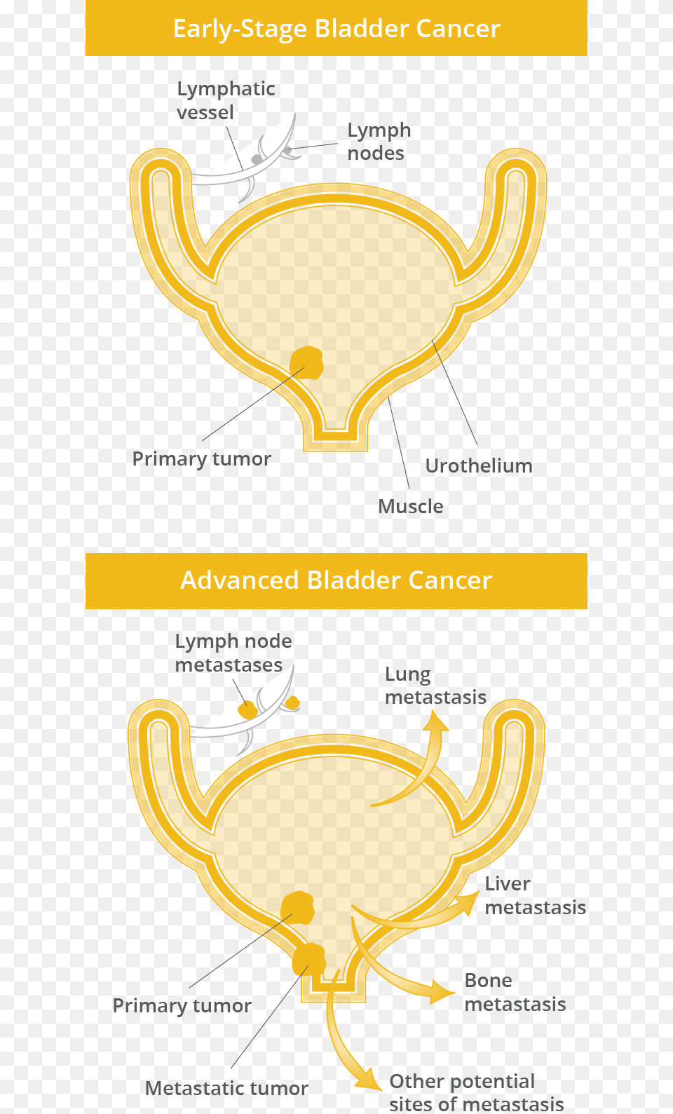 Early Stage Bladder Cancer Showing Little Spread Vs Illustration, Chart, Plot, Dynamite, Weapon Free Transparent Png