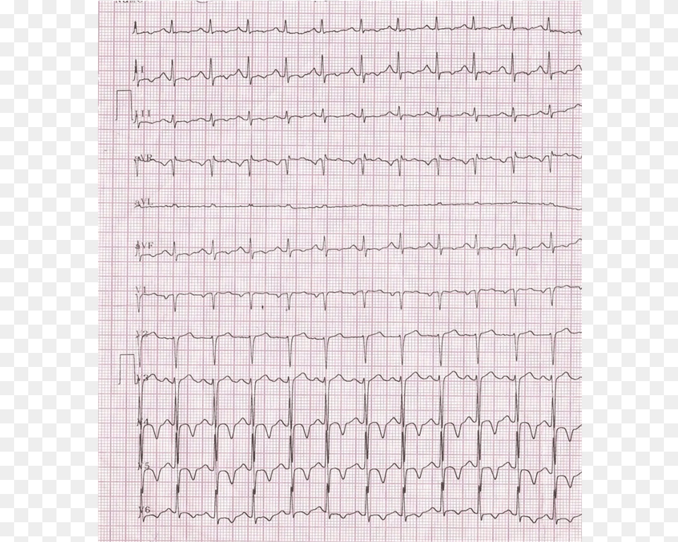 Ecg Showing Sinus Tachycardia And Ischemic Changes, Text, Page Free Transparent Png