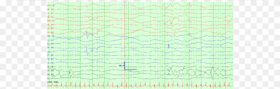 Eeg Background Showing Burst Suppression Pattern Burst Suppression, Chart Free Transparent Png