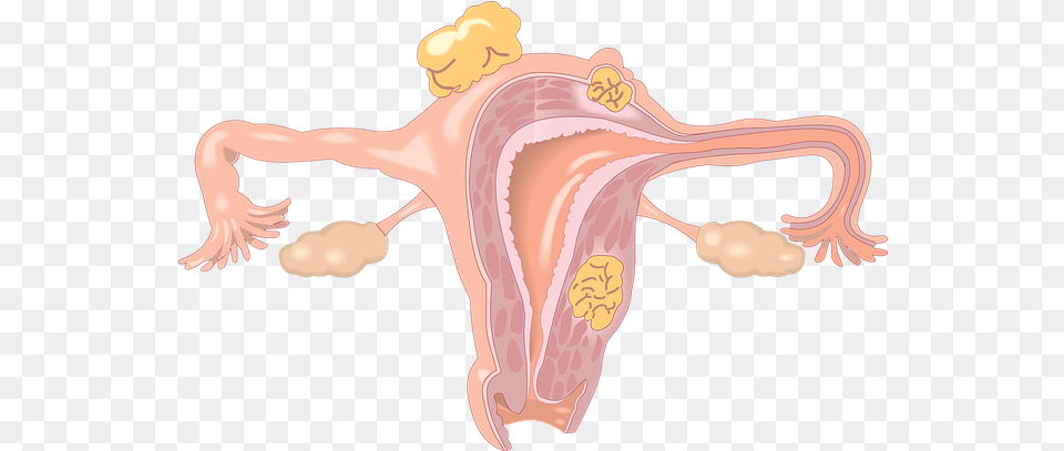 Endometriosis And Fibroids With Connection To Co Dependancy Baby In The Uterus, Animal, Dinosaur, Reptile Free Transparent Png