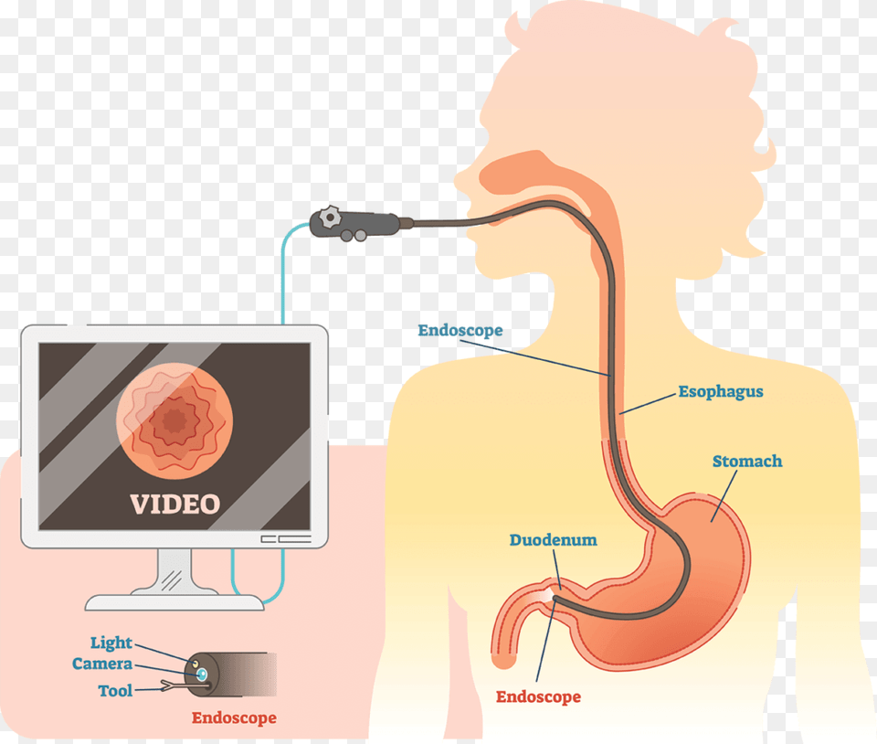 Endoscopic Ultrasound Or Eus Is An Advanced Endoscopic Endoscopy Clipart, Body Part, Stomach, Adult, Female Png Image