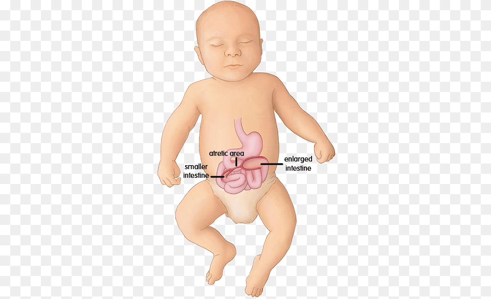 Enlarge Image Duodenal Atresia, Baby, Person Png