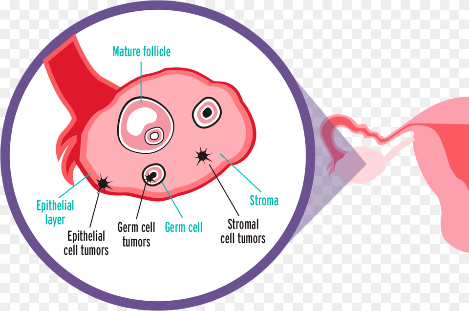 Epithelial Ovarian Cancer Png