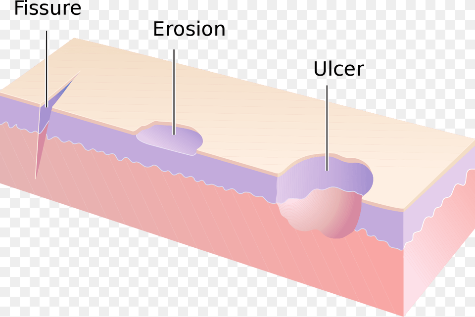 Erosion And Ulcer Difference, Hot Tub, Tub Free Png Download