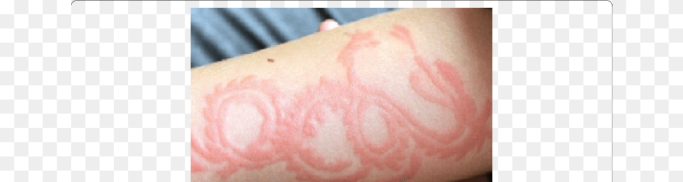 Erythema And Inflammation On The Left Forearm Of A Inflammation, Body Part, Hand, Person, Skin Png Image