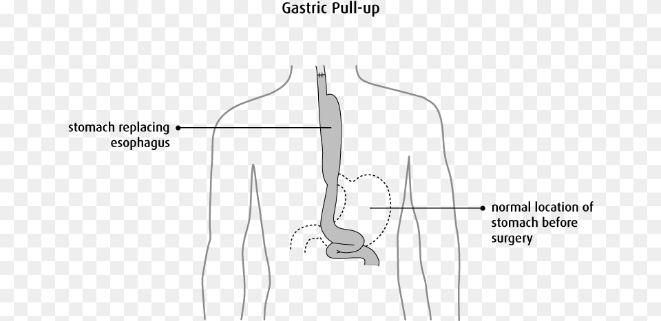Esophageal Cancer Gastric Pull Up, Ct Scan Png