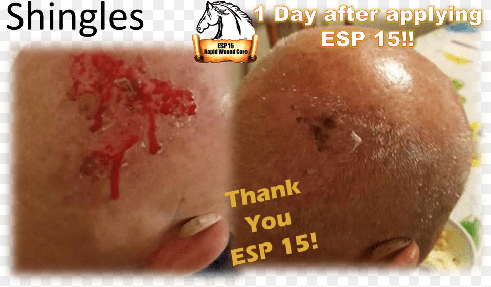Esp 15 Used On Shingles On The Back Of A Man S Head Bun, Injury, Person, Face Free Png Download