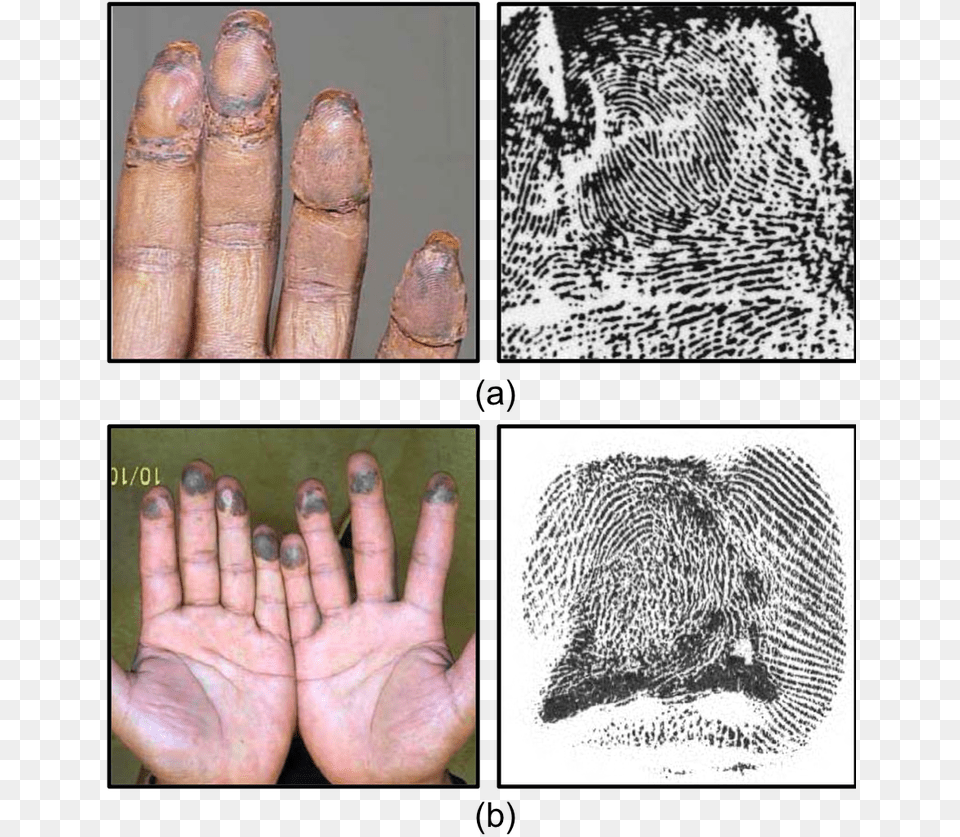 Example Of Altered Fingerprints Fingerprint Alteration, Hand, Body Part, Person, Finger Png