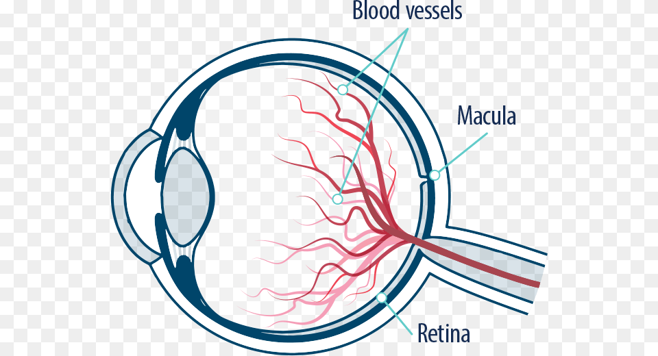 Eye Blood Vessels Macula And Retina Retinal Vein Occlusion Cartoon Free Png