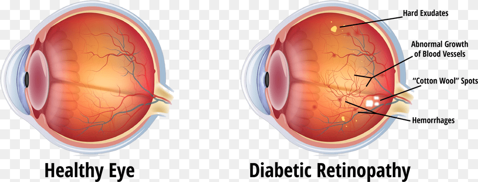 Eye During Diabetic Retinopathy, Ct Scan, Arrow, Weapon Png