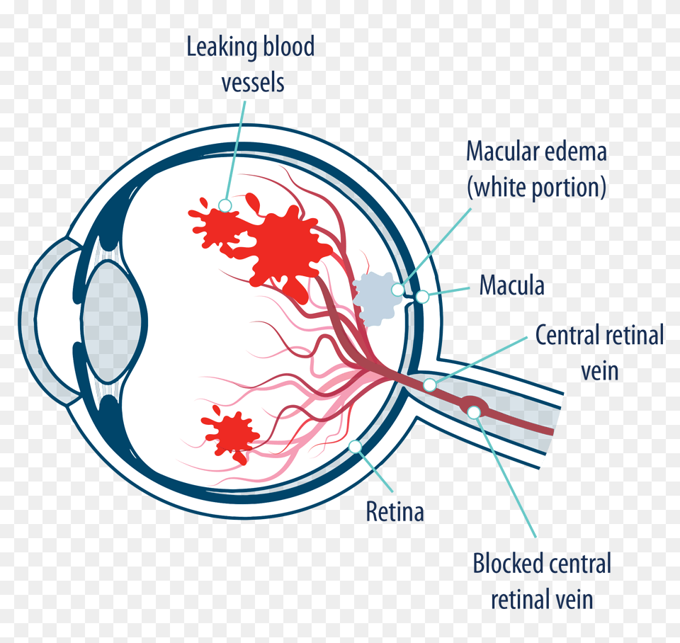 Eye With Macular Edema Following Retinal Vein Occlusion, Disk Free Png Download