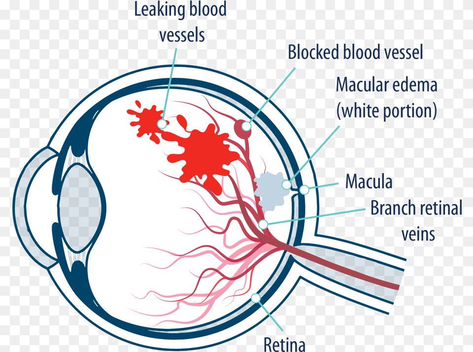Eye With Macular Edema Following Retinal Vein Occlusion Macula Of Retina, Cutlery Png