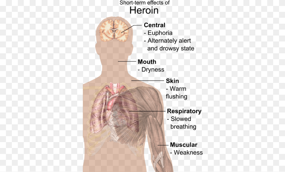 Fatality Rate For Heroin And Cocaine Users Is 14 Higher Than Short Effects Of Heroin, Adult, Female, Person, Woman Png Image