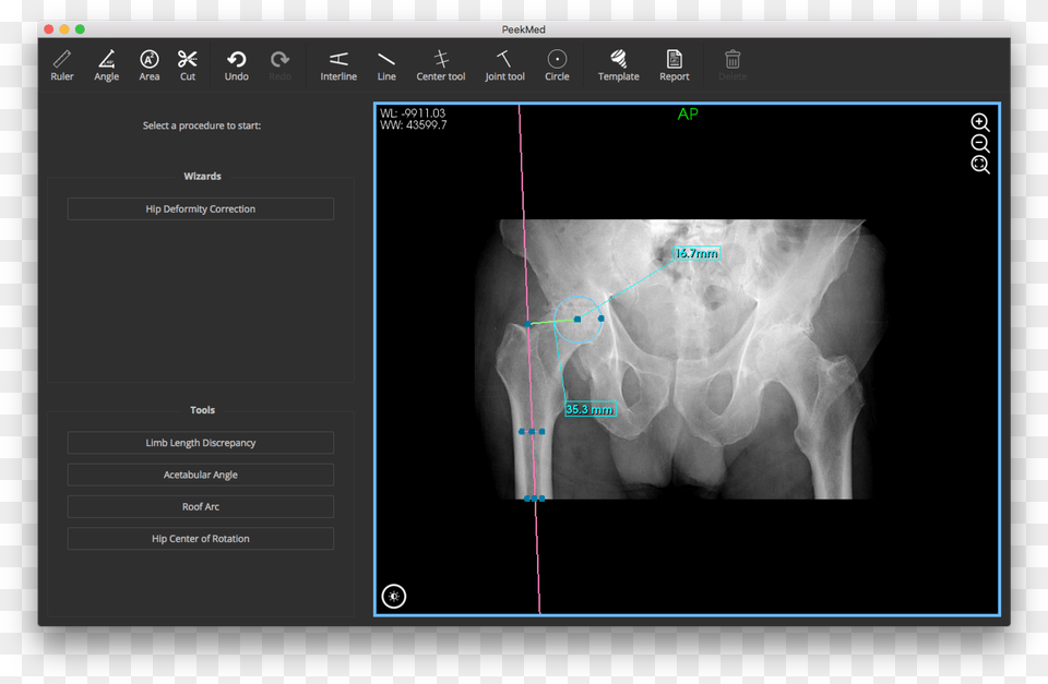 Femoral Acetabular And Combined Offset Scoliosis, Ct Scan, Adult, Bride, Female Free Transparent Png