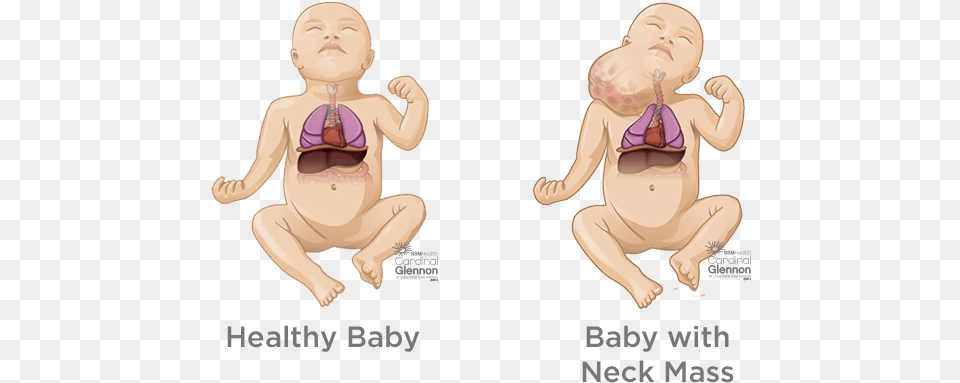 Fetal Neck Masses Fetal Teratoma Neck, Clothing, Swimwear, Baby, Person Free Png