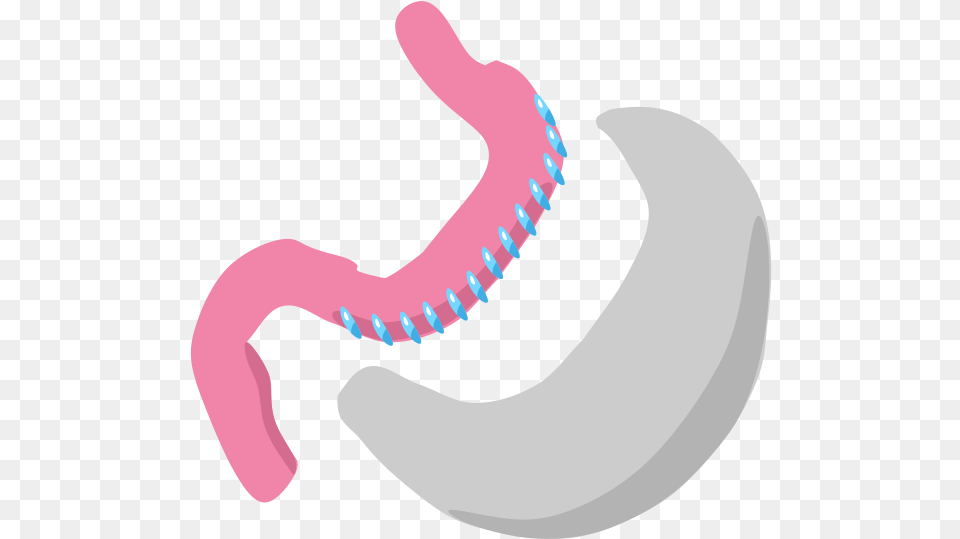 Fig 1 In A Sleeve Gastrectomy The Greater Curvature Gastrectomia Vertical, Body Part, Stomach, Toothpaste, Smoke Pipe Free Png Download