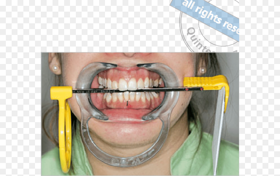 Fig 2 Radiographic Paralleling Technique With Lip Expander Tongue, Mouth, Teeth, Body Part, Person Png Image