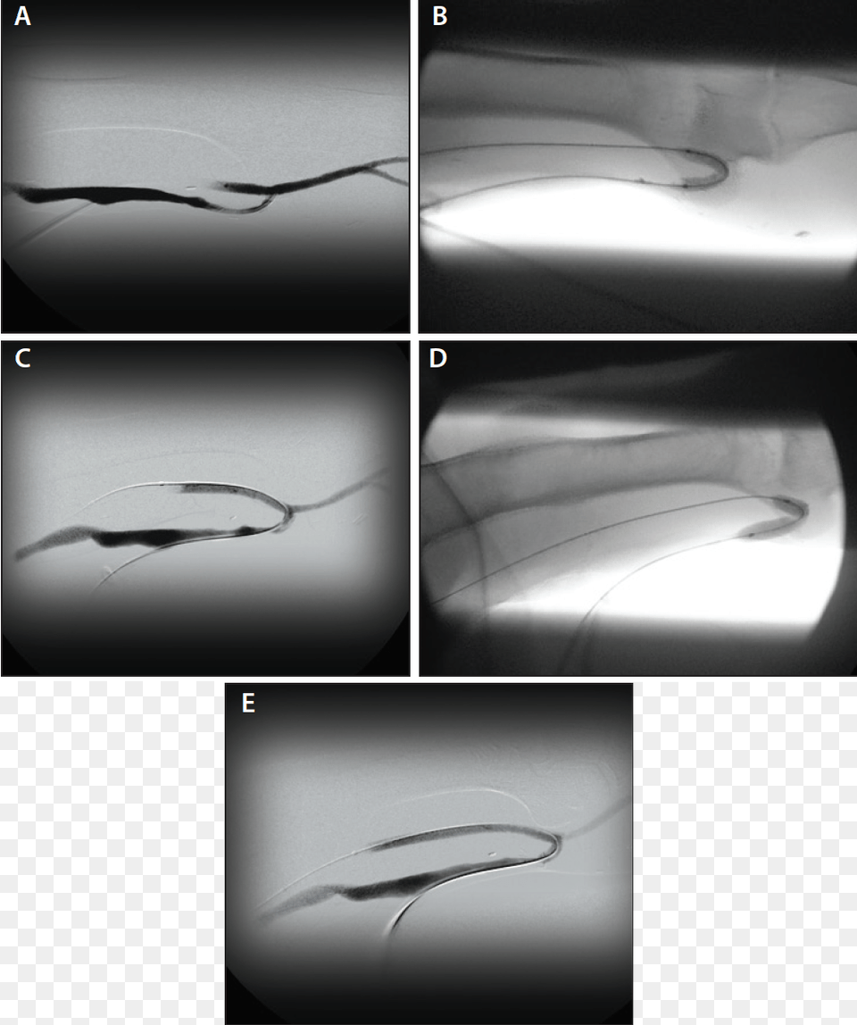 Figure 2 Fistula, Car, Ct Scan, Transportation, Vehicle Png Image