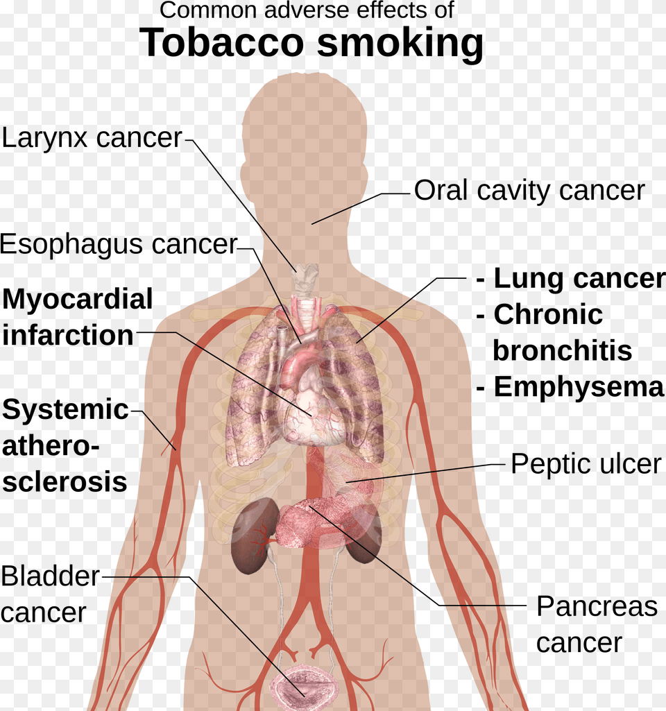 File Adverse Effects Of Smoking Wikimedia Anafilakticki Sok, Adult, Male, Man, Person Free Png