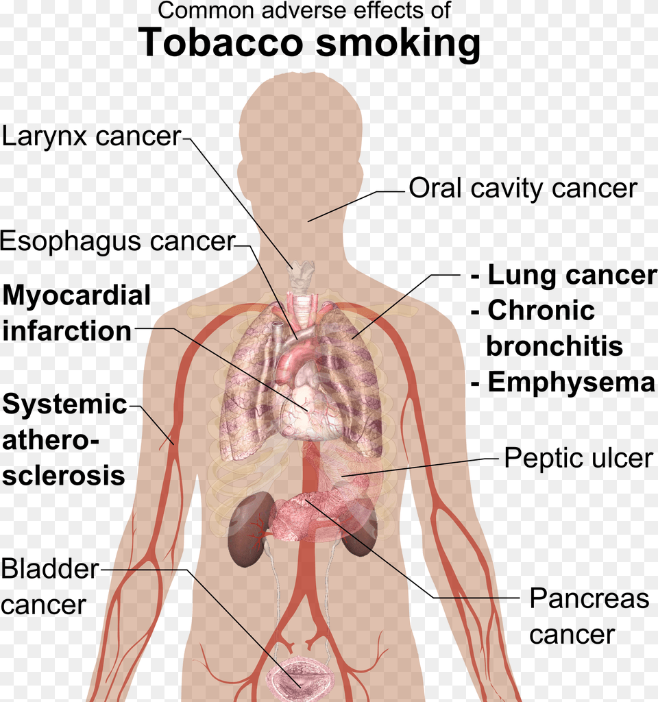 Fileadverse Effects Of Tobacco Smokingpng Wikimedia Commons Physical Effects Of Smoking, Adult, Male, Man, Person Free Png Download
