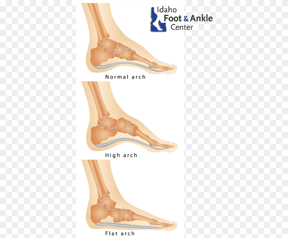 Flat Feet Amp Other Foot Deformities Fallen Foot Arch, Ankle, Body Part, Person, Smoke Pipe Free Transparent Png