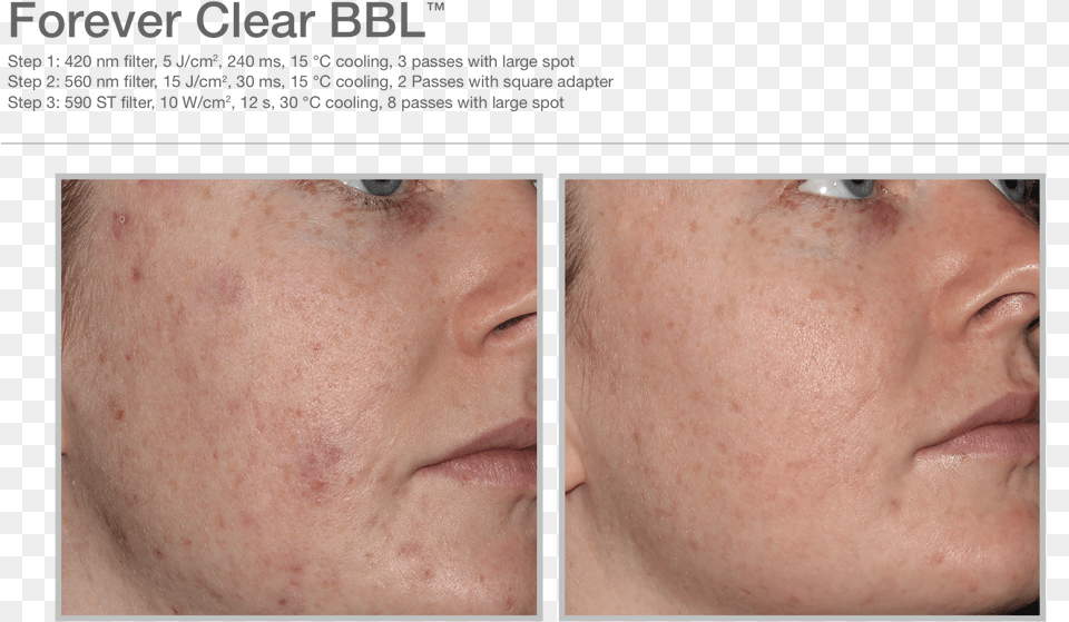 Forever Clear Bbl Before And After, Face, Head, Person, Freckle Png Image