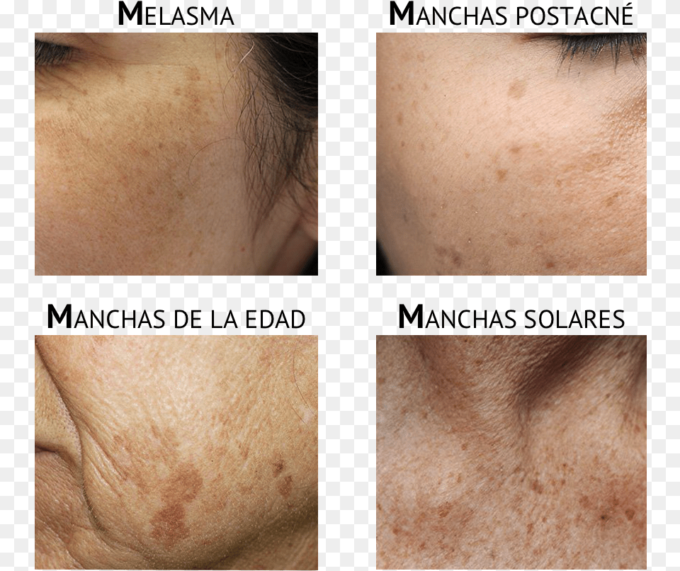 Freckle, Body Part, Face, Head, Neck Png Image