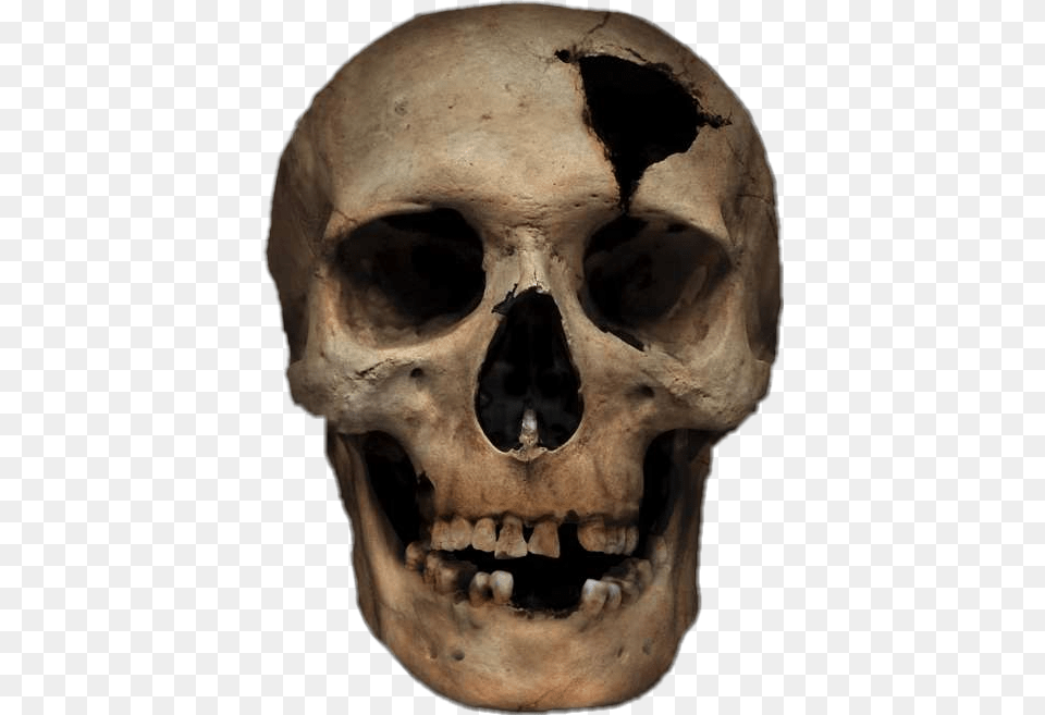 Freetoedit Skull Cracked Stickerart Blunt Force Trauma Skeleton, Person, Head Png