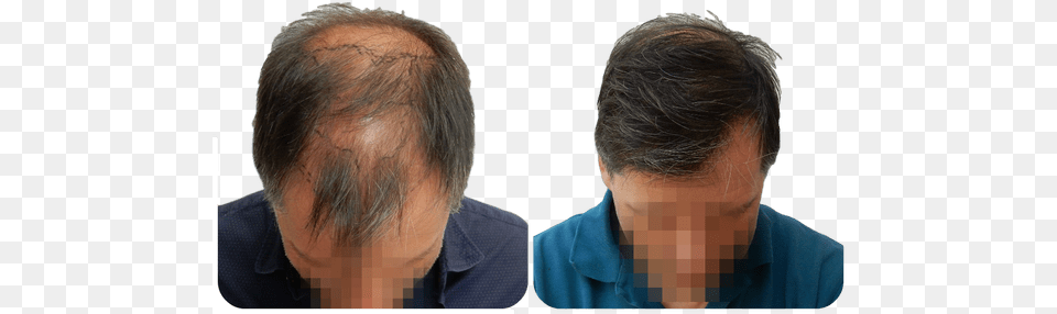 Fue Hair Transplant Procedure Advantages And Cost By Fue Hair Transplant Results, Person, Face, Head, Adult Png