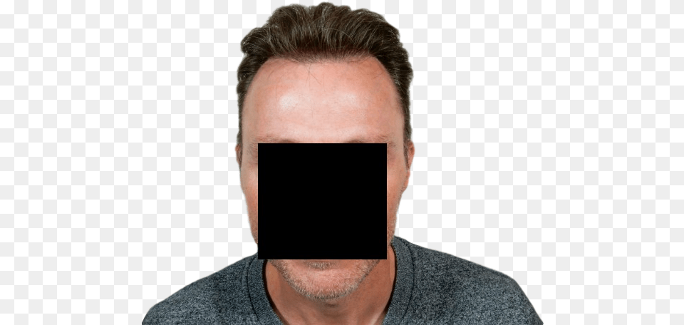Fue Hair Transplantation Smartphone, Face, Head, Person, Photography Free Transparent Png