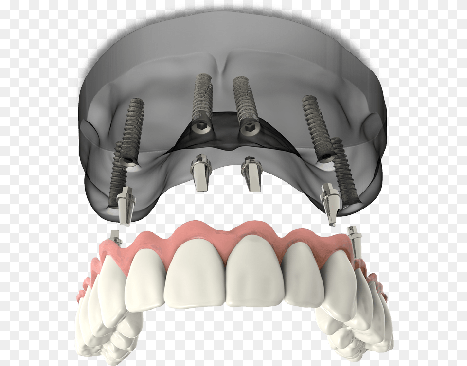Full Arch Dental Implants Model Falls Church Va Bicycle Pedal, Body Part, Mouth, Person, Teeth Free Transparent Png