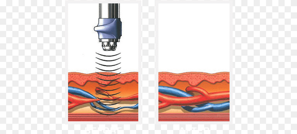 Gainswave For Erectile Dysfunction Gainswave Before And After Free Transparent Png